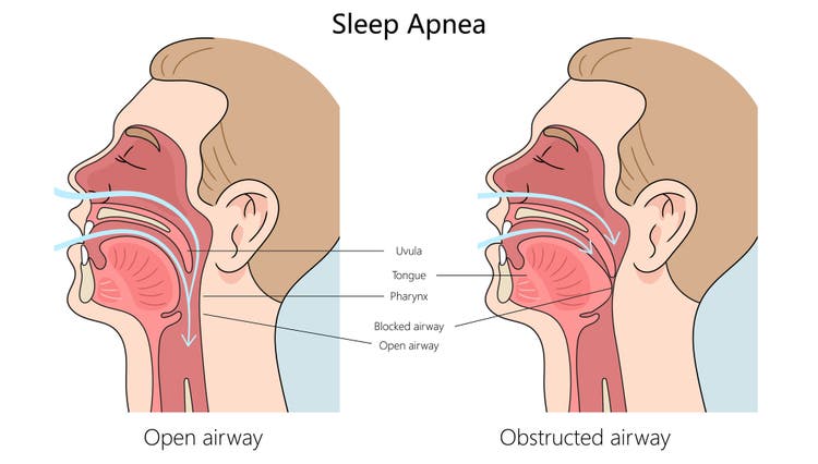 Medical diagram comparing a normal open airway versus an obstructed airway in sleep apnea.